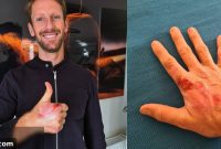 Grosjean Opens Up About His Right Hand Burn Injuries